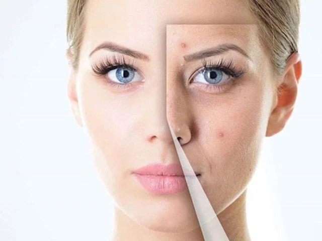 پنج اشتباه رایج جوش و لک.وچطور از آنها جلو گیری کنیم