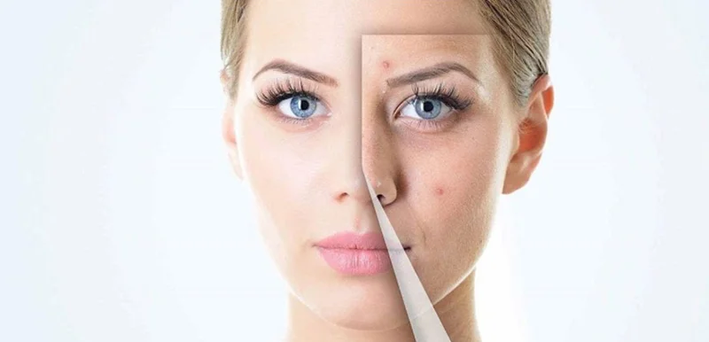 پنج اشتباه رایج جوش و لک.وچطور از آنها جلو گیری کنیم